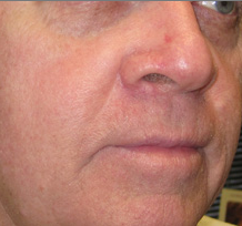 mole removal