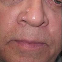 mole removal