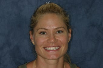 Short, Discolored Teeth Treated with da Vinci Porcelain Veneers