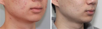 Buccal Fat Before and 2 Month After