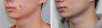 Buccal Fat Before and 2 Month After
