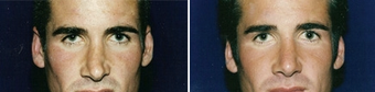 Non-surgical Rhinoplasty, Before and After