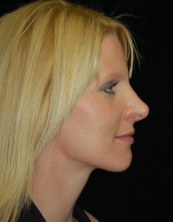 Revision Rhinoplasty