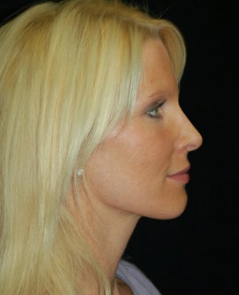Revision Rhinoplasty