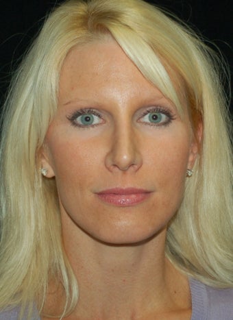 Revision Rhinoplasty