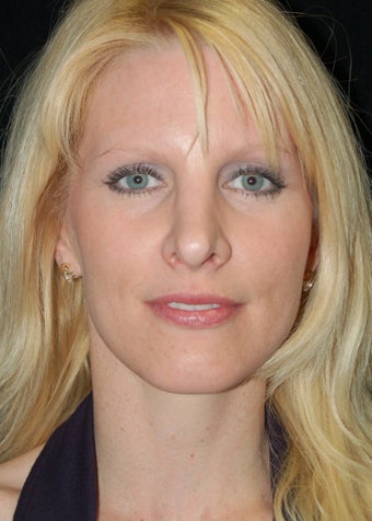 Revision Rhinoplasty