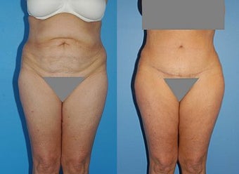 Abdominoplasty