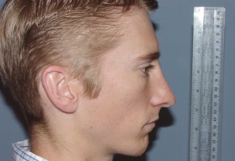 Correction of excessively thinned out nose following primary nasal surgery