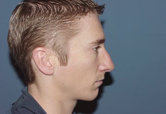 Correction of excessively thinned out nose following primary nasal surgery