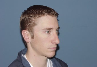 Correction of excessively thinned out nose following primary nasal surgery