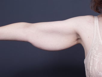49 year old with sagging arm skin