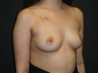 Breast reconstruction - Implants