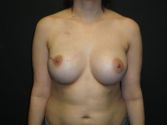 Breast reconstruction - Implants
