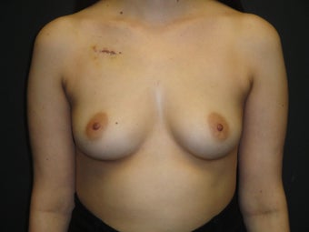 Breast reconstruction - Implants