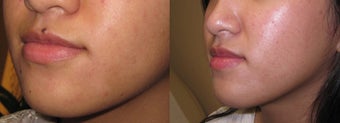 Mole removal using plastic surgery techniques