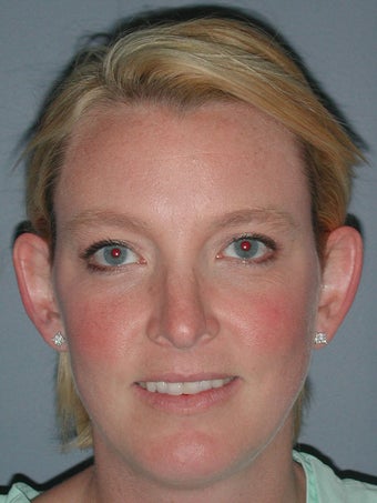 Otoplasty, Ear Surgery