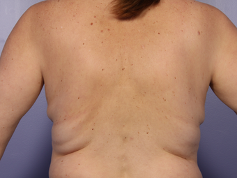 Zeltiq CoolSculpting