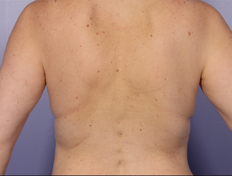 Zeltiq CoolSculpting