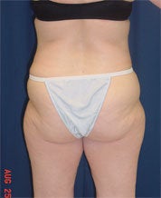 Bodylift