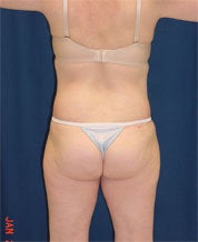 Bodylift