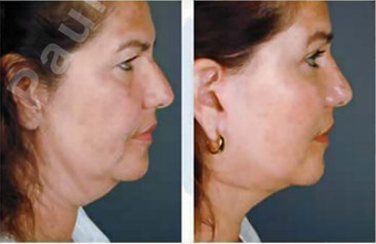 Complete Facial Rejuvenation