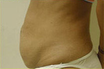 Tummy Tuck