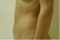 Tummy Tuck