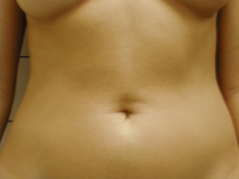 SmartLipo Abdomen