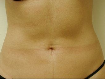 SmartLipo Abdomen