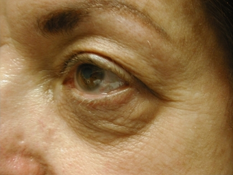 Fractional CO2 Laser Resurfacing - The Madonna Lift