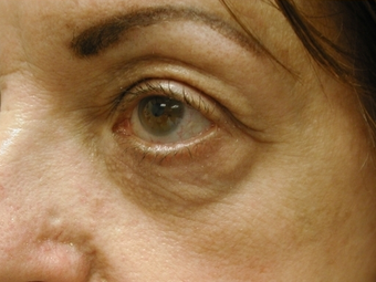 Fractional CO2 Laser Resurfacing - The Madonna Lift