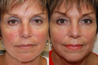 Non-Surgical Facial Rejuvenation with Silikon-1000