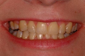 Zoom Advanced Power Inoffice Tooth Whitening
