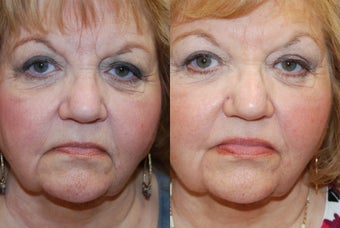 Non-Surgical Facial Rejuvenation with Silikon-1000