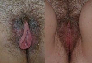 Labiaplasty