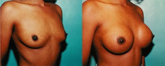 Breast Implants