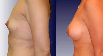 Breast Implants