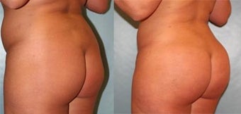 Brazilian Butt Lift