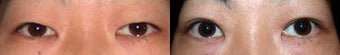 Asian Eyelid Surgery