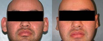 Otoplasty