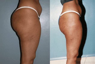 Liposuction
