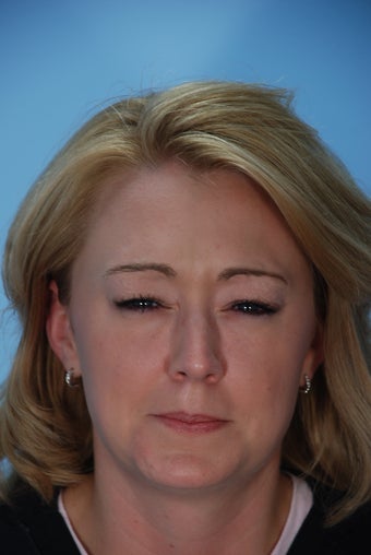 Botox