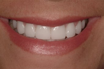 Porcelain Veneers