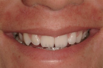 Porcelain Veneers