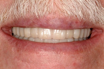 Full mouth reconstruction with crowns and bridges