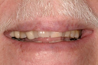 Full mouth reconstruction with crowns and bridges