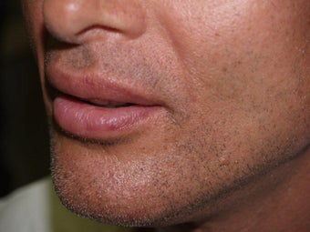 Lip augmentation and lift