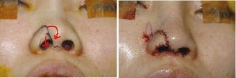 Nostril notch reapir