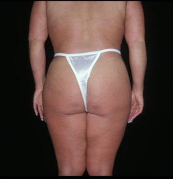 Lower Body Lift