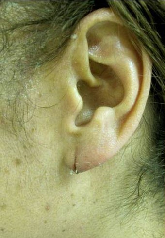 Earlobe Repair